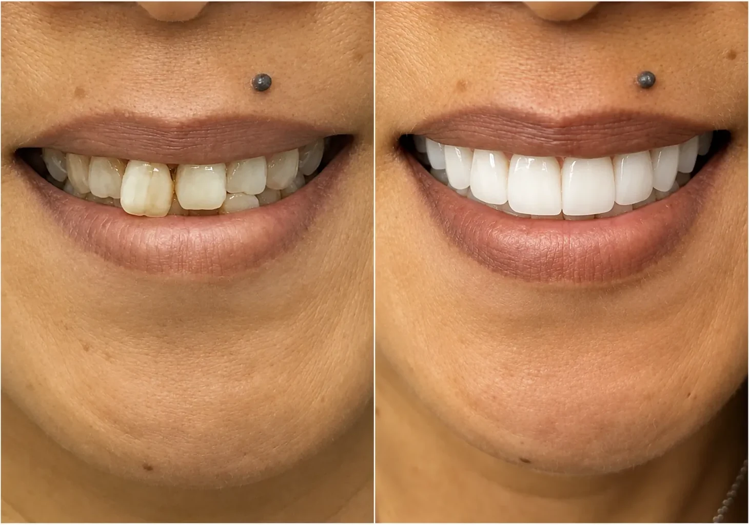 Close-up smile before and after a shade-matched single implant crown