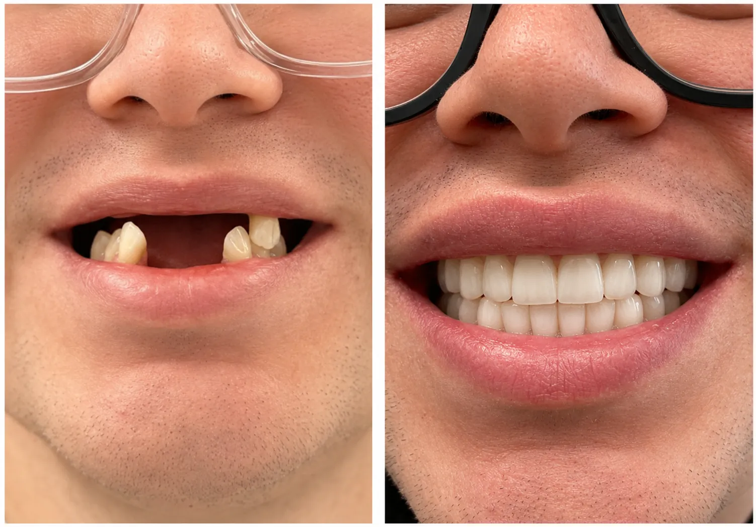Close-up smile before and after replacing missing front teeth with implants