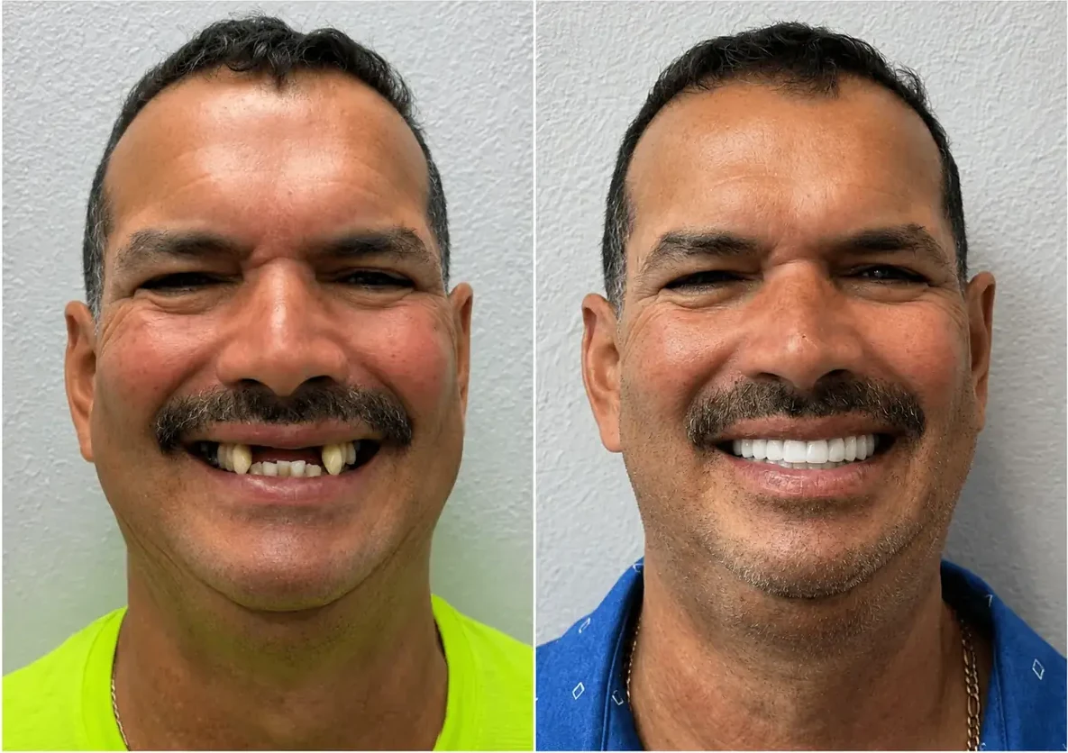 Patient smile before and after full-arch dental implant treatment