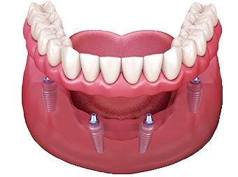 All On 4 Dental Implants at 3D Dental