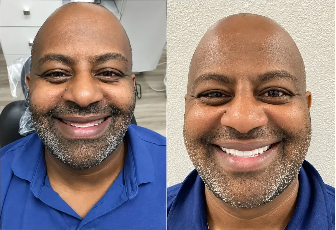 Patient smile before and after implant-supported crowns