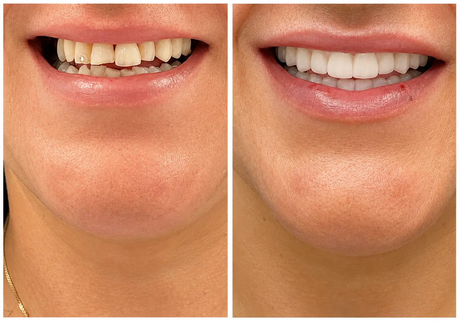 Close-up smile before and after closing gaps with veneers