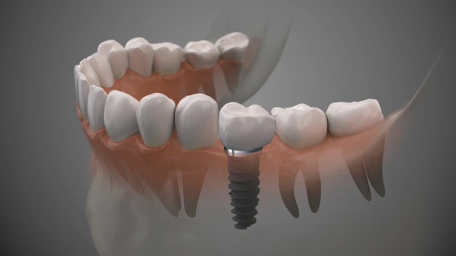 Dental Implants at 3D Dental