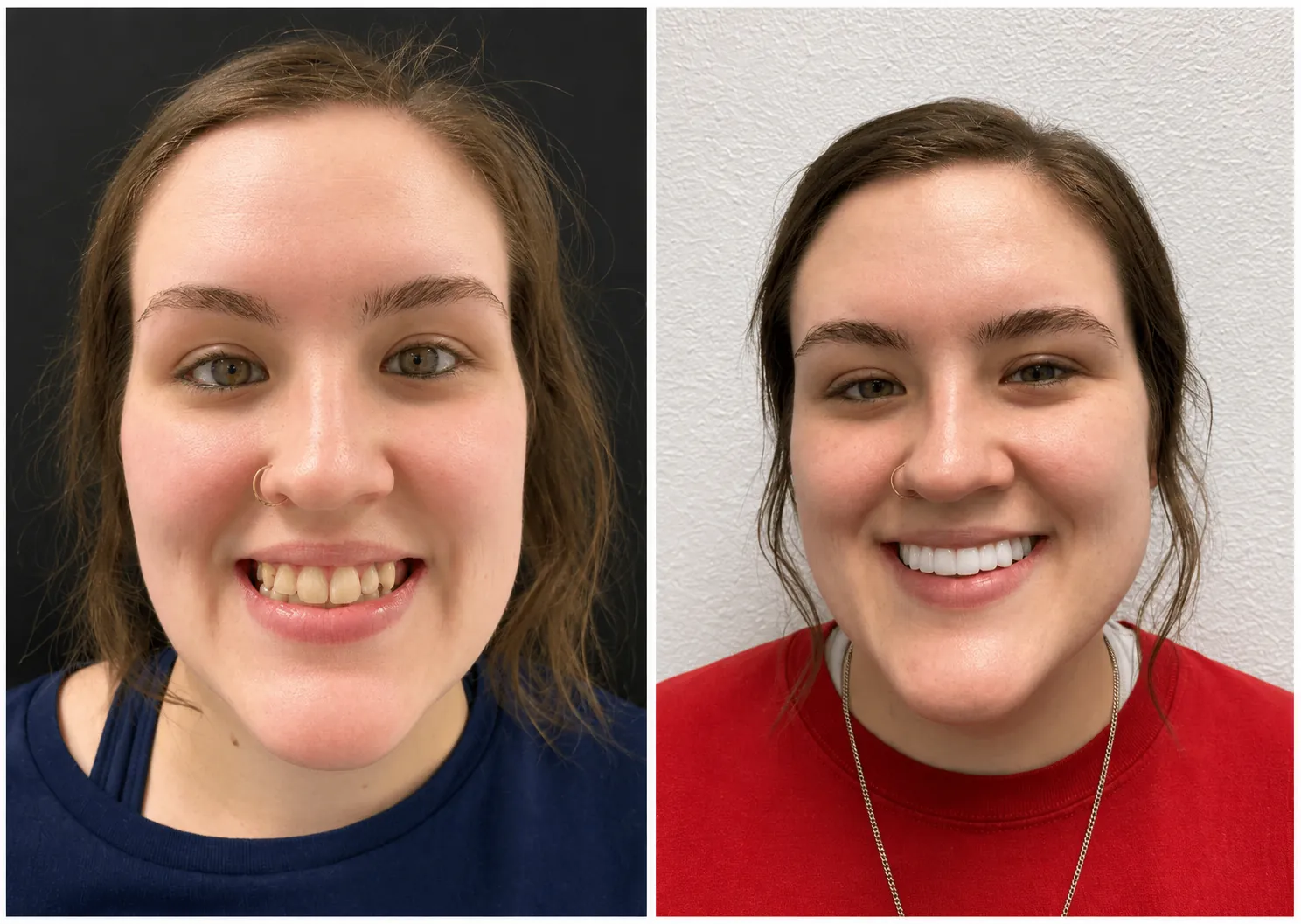 Patient portrait before and after a full smile makeover with crowns