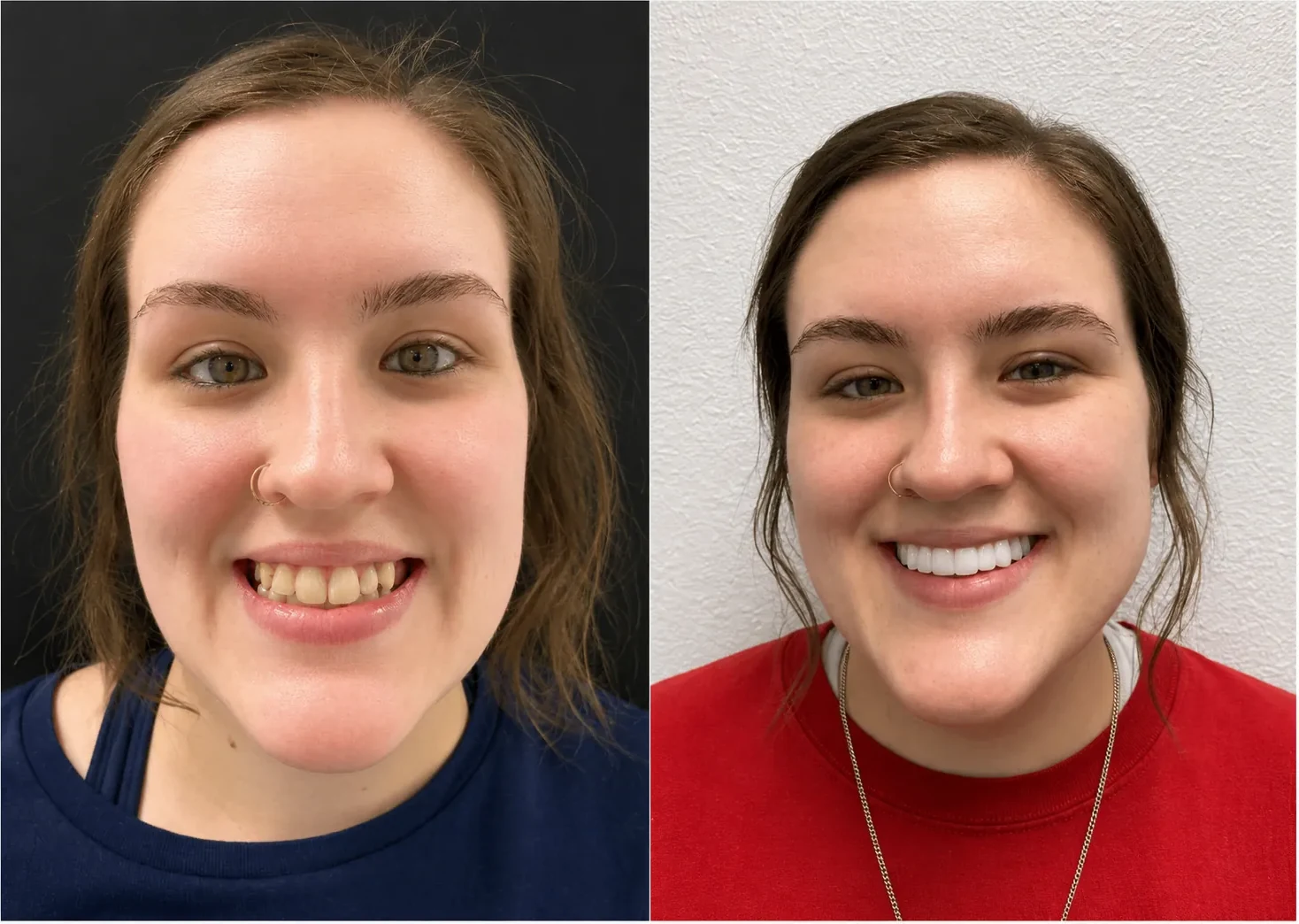 Patient portrait before and after a full-arch implant smile makeover