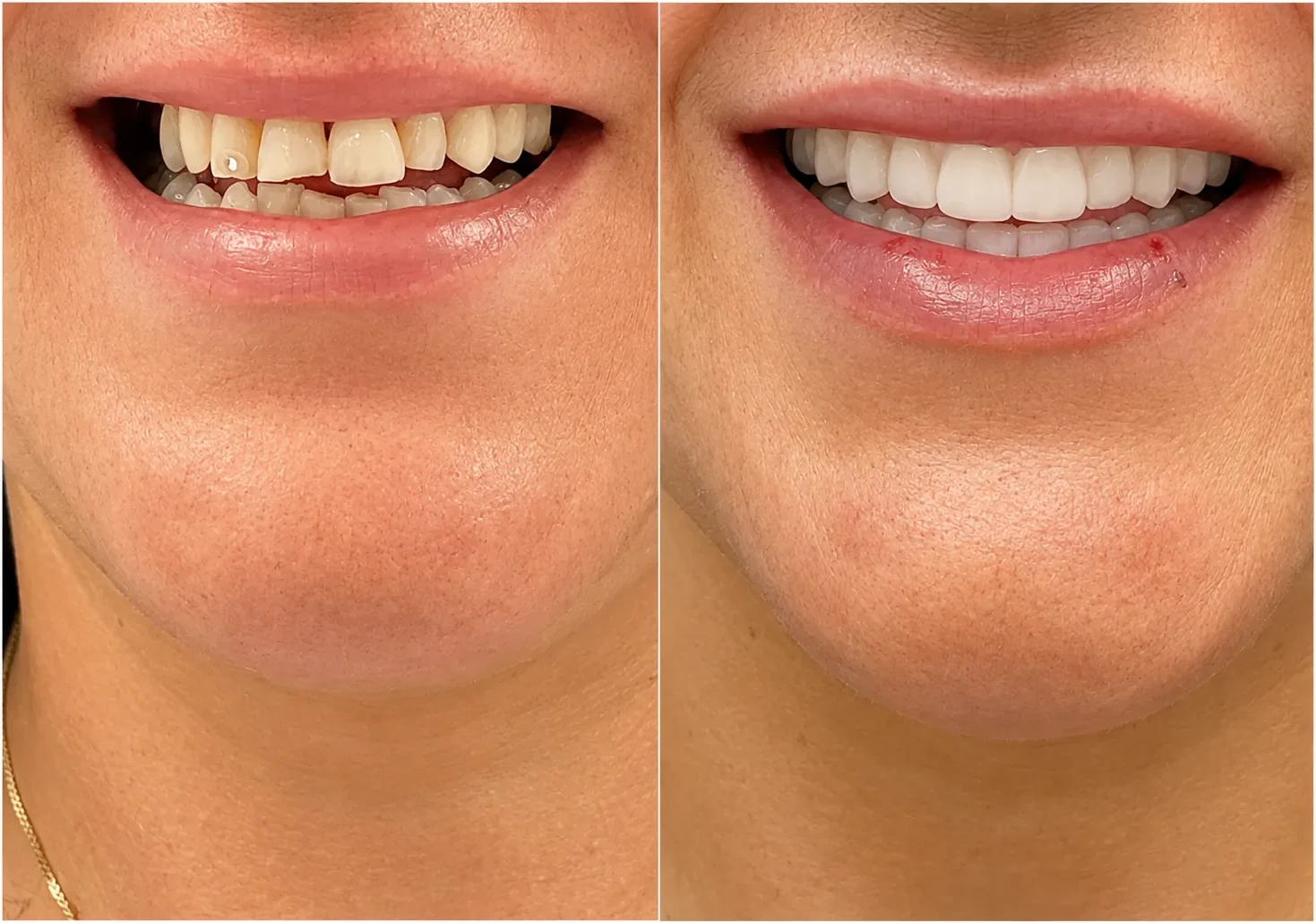 Close-up smile before and after replacing missing teeth with implants