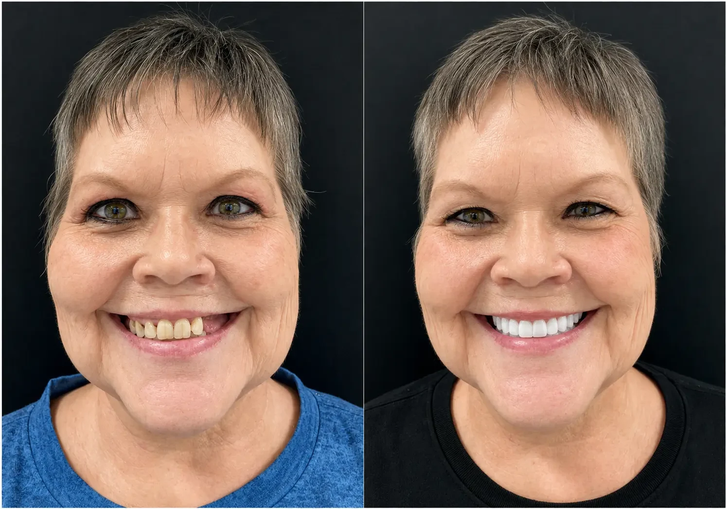 Patient portrait before and after implant-supported denture treatment