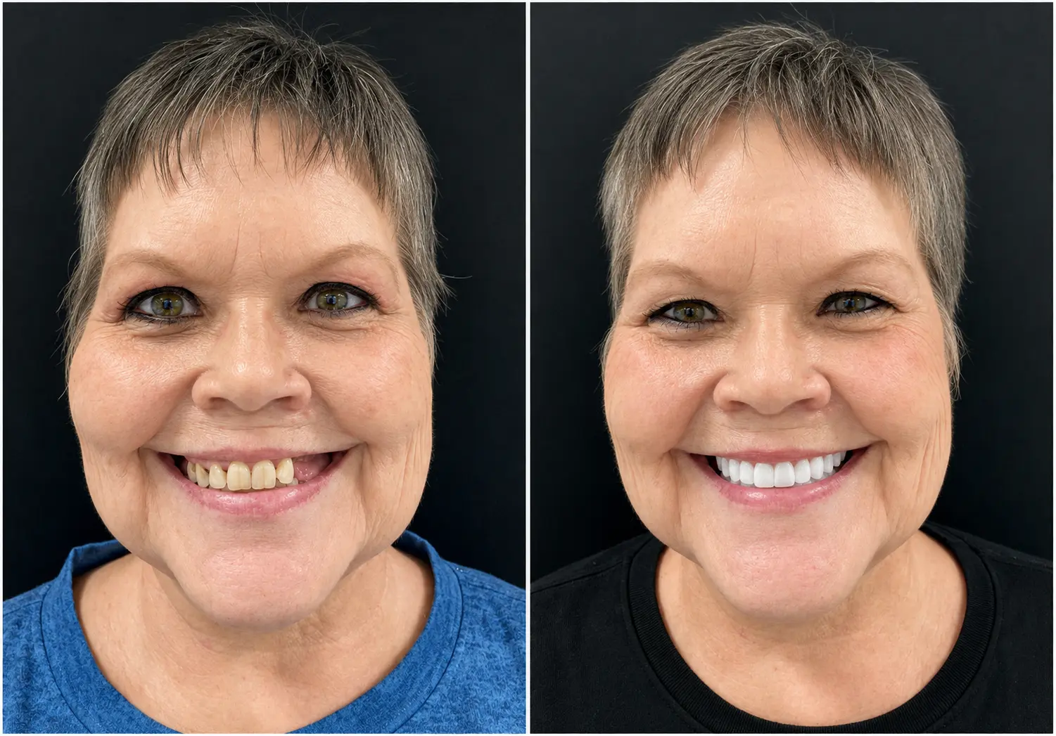 Patient portrait before and after implant-supported denture treatment