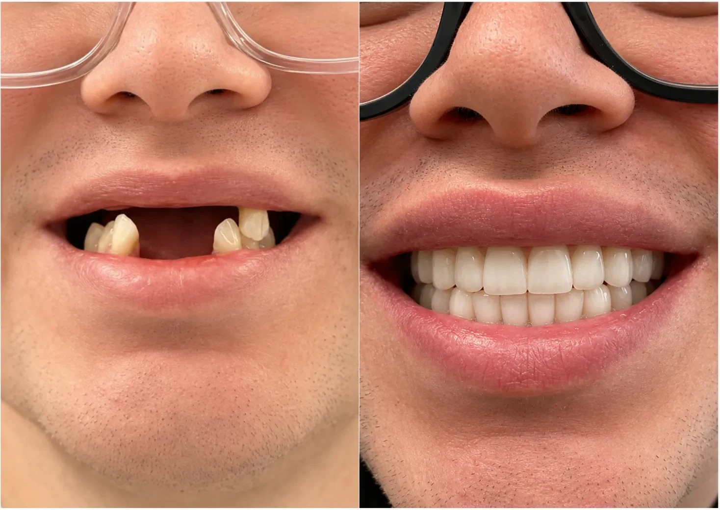 Close-up smile before and after replacing missing front teeth with implants